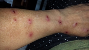 Morgellons Disease Lesions on Wrist