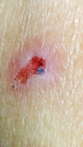 Morgellons Disease Lesion Close Up